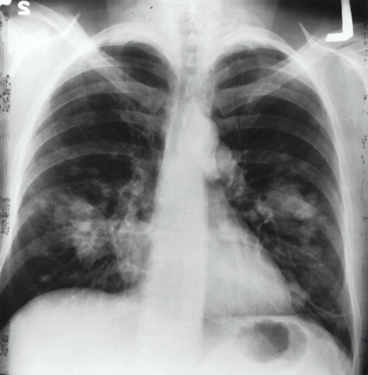 Lung Cancer Sample Case